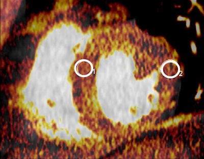 A 45-year-old man with stenosis of the left anterior descending artery (LAD). The image in the top row was obtained at rest and in the bottom row during pharmacological stress. DECT showed normal iodine concentrations during rest, but at stress the iodine concentration within the antero-septal myocardium is decreased with a quantitative iodine concentration measurement of 0.6 mg/mL compared with 3.4-3.8 mg/mL in healthy myocardium at rest and stress. Clinical images not from phantom study courtesy of Dr. Felix Meinel.