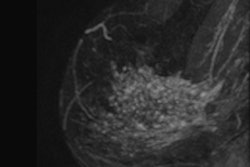 2013 11 04 12 32 14 365 2013 11 04 Breast Mri Thumb