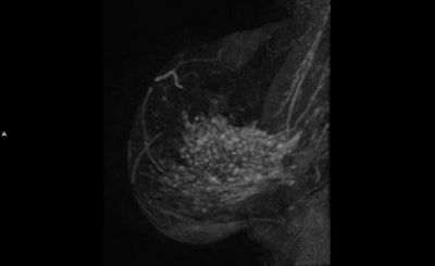 ILC maximum intensity projection sagittal