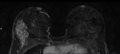 A 45-year-old woman with invasive lobular carcinoma (ILC) in her right breast shown as heterogeneous segmental nonmass enhancement of 75 mm on preoperative breast MRI (axial and sagittal maximum intensity projection). The ILC was mammographic occult and only 8 mm on ultrasound. After pathological proof of the more extensive size, the treatment was altered to mastectomy. All images courtesy of Kenneth Pengel and Dr. Claudette Loo.