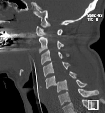 Dislocation injury to the cervical spine after road traffic accident with permanent high paraplegia. Image courtesy of Dr. Stefan Wirth.