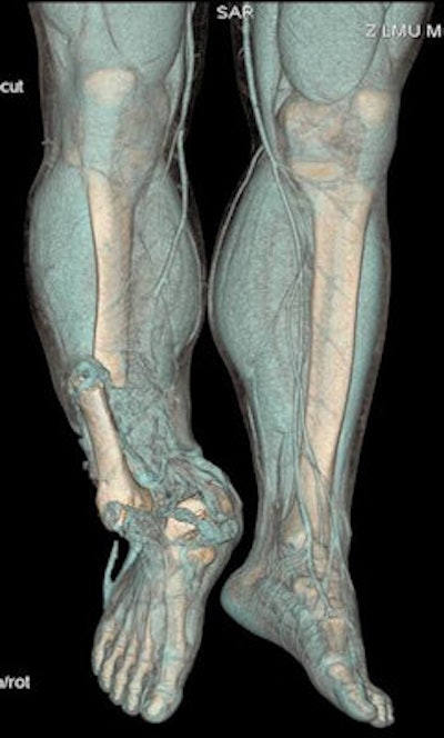 CT volumetric representation of a complex amputation injury of the right lower extremity due to trauma sustained from road traffic accident. Image courtesy of Dr. Stefan Wirth.