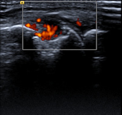 Elderly patient with established and treated rheumatoid arthritis. The patient complained of increased pain and stiffness. Ultrasound shows active synovitis and erosions in multiple metacarpo-phalangeal joints (a = grayscale image, b = power Doppler image). Ultrasound is a useful tool to assess for the presence and to an extent severity of (subclinical) inflammation. Clinical examination can be surprisingly insensitive even in florid inflammation, as shown here. Images courtesy of Dr. Bernhard Tins.