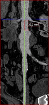 Left: Centerline-of-flow (green) generated by the 3D workstation. Right: Stretched curved planar reformation (CPR) view of same image. This view was generated to accurately measure infrarenal AAA neck length. All images courtesy of Dr. Stéphan Haulon, PhD.