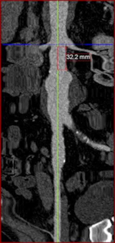 Left: Centerline-of-flow (green) generated by the 3D workstation. Right: Stretched curved planar reformation (CPR) view of same image. This view was generated to accurately measure infrarenal AAA neck length. All images courtesy of Dr. Stéphan Haulon, PhD.