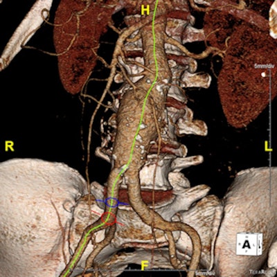 Centerline-of-flow (green) generated by the 3D workstation
