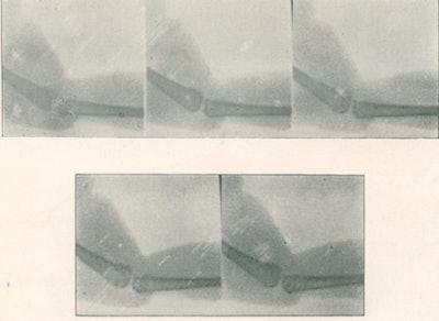 Cineradiograph of a frog's leg (1897).