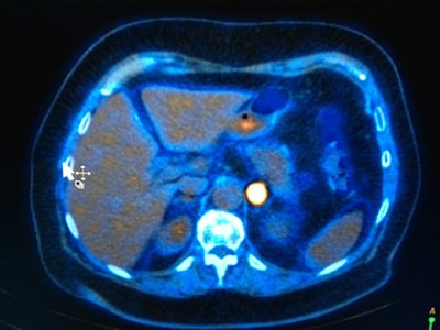 A shift toward nuclear medicine technologies is occurring. This PET/CT image shows abnormal uptake of isotope in the left para-aortic region. Image courtesy of Dr. Richard Fowler.