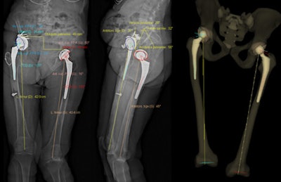 An example of 3D modeling performed with the EOS system for the assessment of total hip arthroplasty. Image courtesy of Dr. Cyrille Delin.