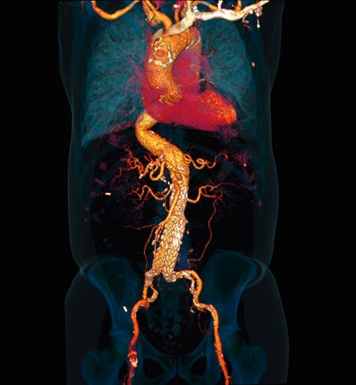 Dynamic CT angiography of 64 cm acquired with spiral 4D mode at 80 kV, 110 mAs, with 45 mL of contrast. The vascular structures of the complete trunk are clearly demonstrated, and the suspected leaking from the aortic stent could be confidently ruled out. Image © Department of Clinical Radiology and Nuclear Medicine, University Medical Centre Mannheim, Medical Faculty Mannheim, Heidelberg University.