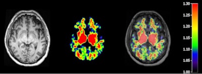 T1-weighted MR (left panel), C-11 PiB PET (middle panel), and fused image (right panel) from a patient 48 hours following severe traumatic brain injury. Image courtesy of Dr. David K. Menon, PhD.