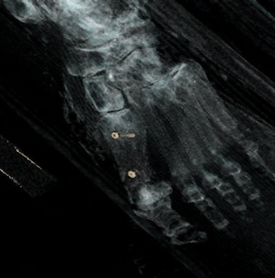 Left foot