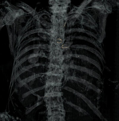 Postmortem multislice CT explorations of two different unknown bodies, with reconstructions in volume-rendering technique mode permitting detection of metal. Above: Chest level: Detection of metallic foreign bodies secondary to surgery of the neck (metallic surgical clips due to surgery of the thyroid) and the chest (metallic wire on the sternum secondary to heart surgery). Below: Left foot: Detection of two surgical screws within the first metatarsal secondary to surgery. Images courtesy of Dr. Fabrice Dedouit, PhD.