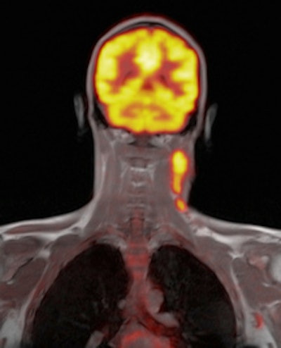 Left: Axial F-18 FDG PET uptake in the same patient is illustrated within the left cervical lymph node in keeping with increased glucose metabolic activity. Right: Coronal Dixon T1-weighted in-phase MR image with superimposed F-18 FDG PET uptake. Left cervical lymphadenopathy is demonstrated in a patient with a known diagnosis of Hodgkin's lymphoma.