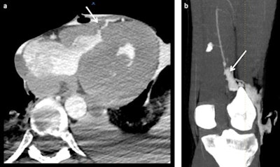 Reconstruction of sharp trauma lesions resulting from stab wounds. The first case (a) shows a stab wound trajectory in the chest with an intramyocardic trajectory. The second case (b) shows a stab wound in the left leg with a lesion of the popliteal artery (arrow in b).