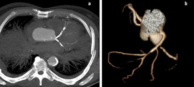 Coronary calcifications and stenoses are shown in 2D and 3D images in two cases of sudden cardiac death due to coronary artery disease.