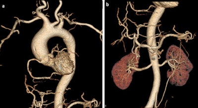 The quality of postmortem angiography using the technique of multiphase PMCTA is high. The vessels of the thorax (a) and abdomen (b) are visible in a volume-rendered 3D reconstruction. All images courtesy of Dr. Silke Grabherr, PhD.