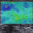 2013 08 15 15 28 21 401 2013 08 16 Breast Ultrasound Pic1 20130815223240
