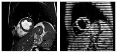 Images show a cross-section of the heart using common MRI techniques (left), compared with the tagged myocardium using CSPAMM (right). Images courtesy of RSNA and Dr. Jonas Dörner.