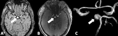 Image A shows 1.5-tesla TOF MRA of a 55-year-old patient with an unruptured basilar aneurysm (arrow). Image B is a corresponding 7-tesla TOF MRA and image C is a maximum intensity projection image. 7-tesla MRA produced superior delineation of the aneurysm with enhanced image sharpness and clarity. Images courtesy of Dr. Lale Umutlu.