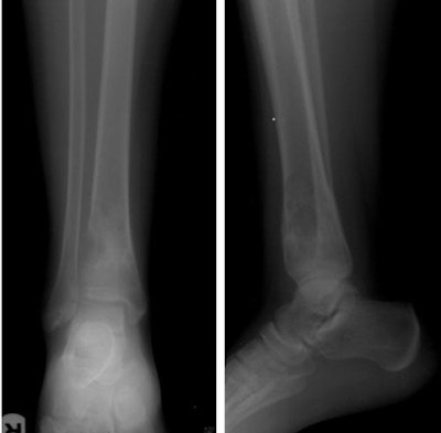 A 15-year-old boy presented with a metaphyseal lucent lesion with well-defined borders that remained quiescent for two years. The patient recently complained of persistent pain and progressive appearance of right ankle swelling. X-ray showed complete changes of the lesion's behavior into a punched-out defect of the distal tibial metadiaphyseal lesion with violated cortex and indeterminate zone of transition, no periosteal reaction or matrix formation were identified. The differential included ruptured chronic bone abscess, Langerhans cell histiocytosis (LCH), and marrow neoplasia. CT-guided biopsy was planned through the large exophytic soft-tissue component seen on CT. This allowed harvesting multiple cores from the main lesion within the bone. The biopsy returned with the result of fibroblastic osteosarcoma. Above, x-ray distal both leg bones and ankle in anteroposterior (left image) and lateral (right image) projections showing distal tibial metadiaphyseal cortical and eccentric lesion with cortical defect and indeterminate medial margin. Neither periosteal reaction nor matrix formations are recognized. Below, axial CT scans of the distal tibial lesion in soft-tissue window setting prior to start of the CT-guided procedure (left image) and bone window setting during the procedure (image at right). All images courtesy of Dr. Mohamed Ragab Nouh.
