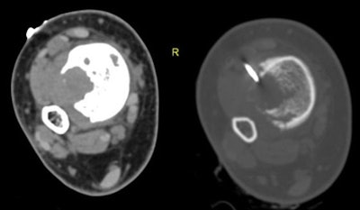 2013 12 19 13 38 19 382 2013 12 20 Bony Lesion Regab bottom