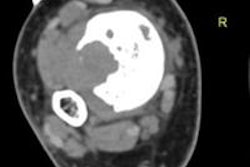 2013 12 19 13 38 19 382 2013 12 20 Bony Lesion Regab bottom 20131219204505