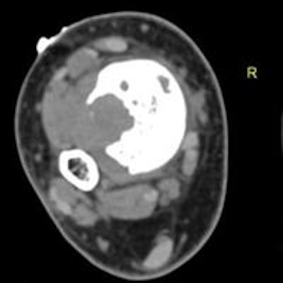 2013 12 19 13 38 19 382 2013 12 20 Bony Lesion Regab bottom 20131219204505
