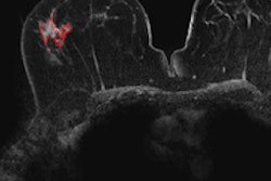 2013 12 11 15 12 44 183 Invasive Dcis 200