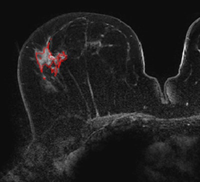 2013 12 11 15 47 42 601 Invasive Dcis 250