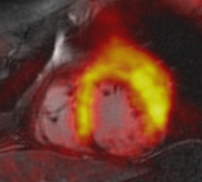 PET/MRI of patient with acute myocardial infarction due to occlusion of the right coronary artery (RCA). The fusion shows that decreased tracer uptake (within the perfusion territory of the RCA) exceeds the area of late gadolinium enhancement. The decreased tracer uptake might delineate the area at risk. Image courtesy of Dr. Felix Nensa.