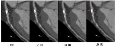 A 54-year-old man with a body mass index of 26.9 underwent coronary CT angiography using a step-and-shoot protocol (140 mAs, 225 mAs, DLP 342.3). In images reconstructed using FBP (left) and various levels of iterative reconstruction (IR) with iDOSE 4 (Philips Healthcare), noise reductions can seen in the IR images (right), but attenuation and plaque volumes are essentially unchanged. Images courtesy of Dr. Richard Takx.
