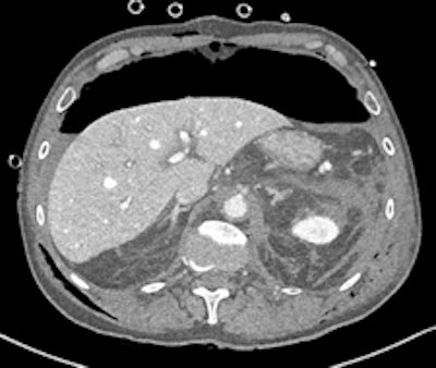 Left: CT performed after laparotomy. Retroperitoneal hematoma in the upper abdomen surrounds the abdominal aorta also involves left perirenal space with thickening of pararenal fascia. A 3.5 mm outpouching from the left lateral wall of the upper abdominal aorta just inferior to the level of the coeliac axis (L1 level) is located short distance anterior to a tiny arterial branch. This is the epicenter of the upper abdominal hematoma and may represent small false aneurysm either from traumatic transection or at the site of avulsion of a small aortic branch. No intimal dissection flap is identified. A large volume pneumoperitoneum is also present. Right image: Repeat CT angiography a week later demonstrated spontaneous thrombosis of the tiny false aneurysm. Image courtesy of Dr. Andrew Lawson and radiopaedia.org. radiopaedia.org/cases/traumatic-abdominal-aortic-false-aneurysm.