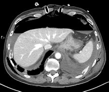 CT after laparotomy