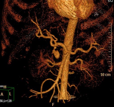 Gastroduodenal artery pseudoaneurysm in a 45-year-old man with pancreatitis and upper gastrointestinal bleed. Image courtesy of Dr. Paresh K. Desai and radiopaedia.org. radiopaedia.org/cases/gastroduodenal-artery-pseudoaneurysm.