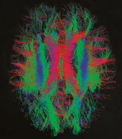 Nerve fiber bundles in a newborn infant's brain. The red tracks are left-right fibers; the green tracks are anterior-posterior fibers; the blue tracks are superior-inferior (top-bottom) fibers. Image courtesy of dHCP.