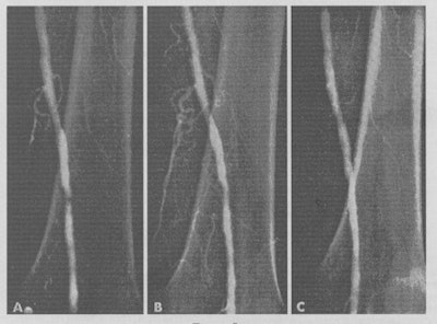 Case one from Circulation, published in November 1964. A: The control angiogram showing threadlike lumen in the region of the adductor hiatus. B: The angiogram performed immediately after dilatation with a 3.2-mm OD catheter. C: The angiogram performed at three weeks.