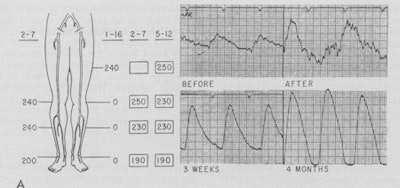 Objective measurements show objective improvement. Blood pressure measurements are recorded as well as plethysmographic waveforms.