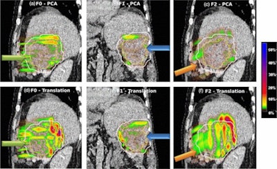 Absolute dose difference of 4D dose distributions considering ground truth motion versus reconstructed motion from either the PCA model (top) or the 2D translation model (bottom) prediction for three fields (the arrows indicate the field direction). All images courtesy of Ye Zhang.