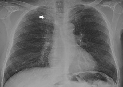 A 65-year-old man with a peripheral pulmonary ground-glass pulmonary nodule. Above: Posteroanterior chest radiography in the upright position shows one suspected pulmonary opacity of the apex of the right lung (arrow) behind the overlying anterior arch of the first right rib. Below: Digital tomosynthesis planes show a ground-glass pulmonary nodule (arrow) with evidence of intralesional air bronchogram. All images courtesy of Dr. Emilio Quaia.