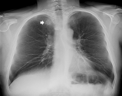 Digital tomosynthesis