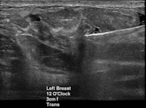 Targeted ultrasound for the palpable lump in the left breast showed vague hypoechoic area at 12 o’clock which was core biopsied under ultrasound guidance (left). Pathology of left breast ultrasound core biopsy was benign, however at multidisciplinary breast care conference, pathology result was found to be discordant with imaging findings on ultrasound, and further evaluation with breast MRI (right) showed an irregular enhancing left breast mass in the upper, central to inner breast which was confirmed to be invasive ductal carcinoma on excisional biopsy.