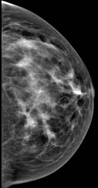 Left mediolateral oblique (left image) and left cranial-caudal (right image) unilateral diagnostic mammogram for a 42-year-old women presenting with new palpable lump in the left upper central breast with no suspicious finding on mammogram. All images courtesy of Dr. Rola Shaheen, originally appearing in the 2014 show Issue of Arab Health magazine.