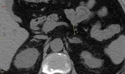 Another adrenal tumor as depicted on a CT scan.