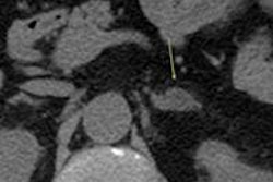 2014 01 29 13 10 30 547 2014 01 30 Lancet Italy Adrenal Incidentaloma 2 20140129201924
