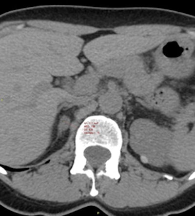 About 4% of CT scans depict subclinical adrenal tumors, as demonstrated in this CT image. All images courtesy of Dr. Cristina Mosconi from the Radiology Unit at S. Orsola-Malpighi Hospital in Bologna, Italy.