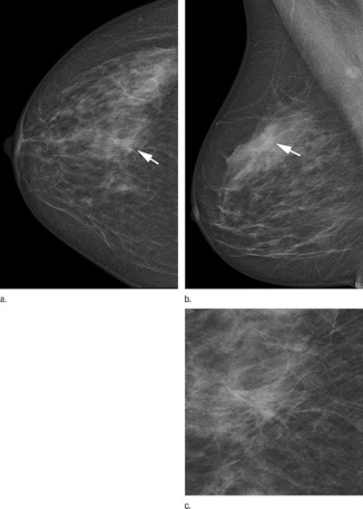 Two-view screening mammograms obtained with the DR photon-counting system show a spiculated mass in the right upper quadrants (arrow). The diagnosis was invasive ductal carcinoma, 8 mm in diameter, as seen on the (a) right craniocaudal image, (b) right mediolateral oblique image, and (c) zoomed in craniocaudal image of the lesion. Images courtesy of RSNA.