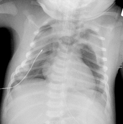 Full-term newborn after cesarean section with pneumomediastinum and pneumothorax on both sides. Image courtesy of Dr. Gabriele Hahn.