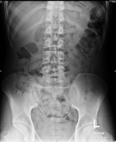 A case with a huge internal payload within the small and large bowel displaying the double condom sign and alignment of the packs representing the tic-tac sign. Radiological interpretation tends to under-report the total amount. In this case, the radiologists counted 45 to 66 concealed packs. The actual internal payload was 84 packs, collected from the feces as evidence.
