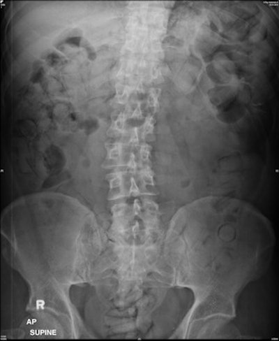 This patient swallowed 64 packs and displays the double condom sign (packs imaged longitudinally) and halo sign (packs imaged transverse). The forensic imaging inexperienced group counted 31 to 50 packs, whereas the forensic imaging experienced group both counted 60 packs -- again under-reporting the entire internal payload. All images courtesy of Dr. Patricia Flach.